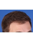 After Hair Transplant&nbsp;Front